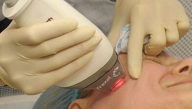 Πώς γίνεται η κλασματική ανανέωση του δέρματος;