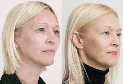 Μέτριο peeling με οξέα φρούτων