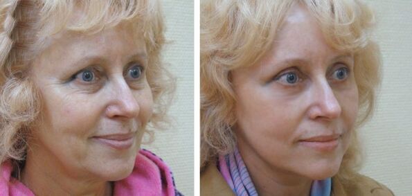 Γυναίκα πριν και μετά την ανανέωση δέρματος προσώπου με πλάσμα